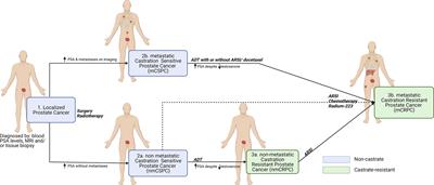 Liquid Biopsy Based Circulating Biomarkers in Metastatic Prostate Cancer